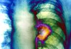 When to suspect lung cancer, and what to do When to suspect lung cancer, and what to do