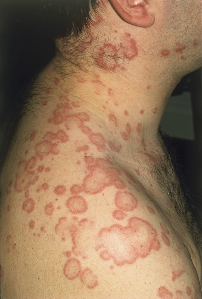 What to look for with drug-induced urticaria - The 