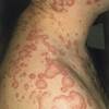 What to look for with drug-induced urticaria What to look for with drug-induced urticaria