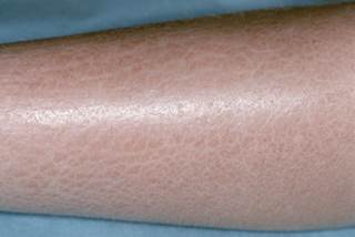 Ichthyosis features abnormal keratinization and resulting in scaling of the skin. Ichthyosis features abnormal keratinization and resulting in scaling of the skin.