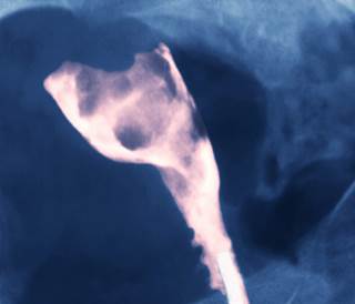 X-ray of a uterus showing an adenocarcinoma (pink). X-ray of a uterus showing an adenocarcinoma (pink).