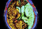 BP variability signals cardiovascular events BP variability signals cardiovascular events