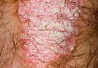 Prescription and OTC creams ineffective against itchy lesions Prescription and OTC creams ineffective against itchy lesions