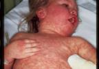 Rash preceded by fever and cough Rash preceded by fever and cough
