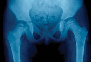 Figure 1. X-ray shows dislocation of the left hip in a 5-year old girl. Figure 1. X-ray shows dislocation of the left hip in a 5-year old girl.