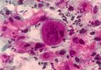Cervical adenocarcinoma after hysterectomy Cervical adenocarcinoma after hysterectomy
