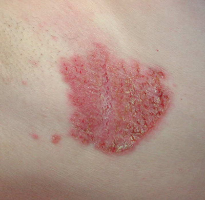 Recurrent erosions on the neck and axillae - The Clinical Advisor