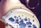 When to start plasmapheresis in a patient with myasthenia gravis When to start plasmapheresis in a patient with myasthenia gravis
