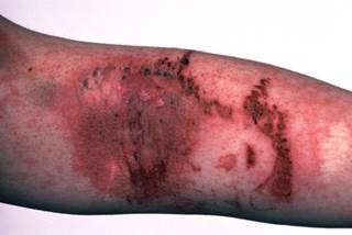 Urticaria pigmentosa is found in most patients with mastocytosis. Urticaria pigmentosa is found in most patients with mastocytosis.