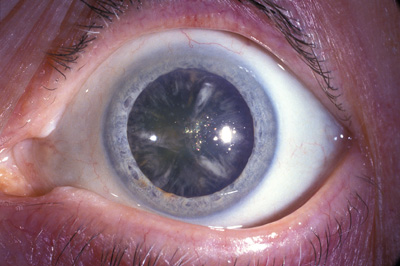 Sun-sensitive drugs may lead to cataracts - The Clinical 