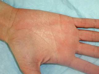 Exposure to moisture leads to palmar rash - The Clinical Advisor