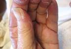 Tender, edematous, red plaques on a woman's hands and feet Tender, edematous, red plaques on a woman's hands and feet