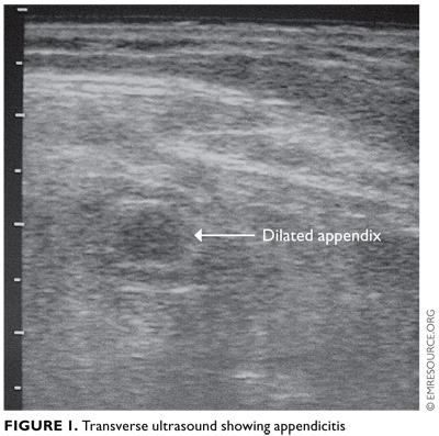 Imaging options for patients with acute abdominal pain - The Clinical ...