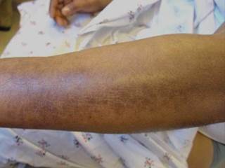 The patient’s condition was marked by tethering of the skin to underlying tissue. The patient’s condition was marked by tethering of the skin to underlying tissue.
