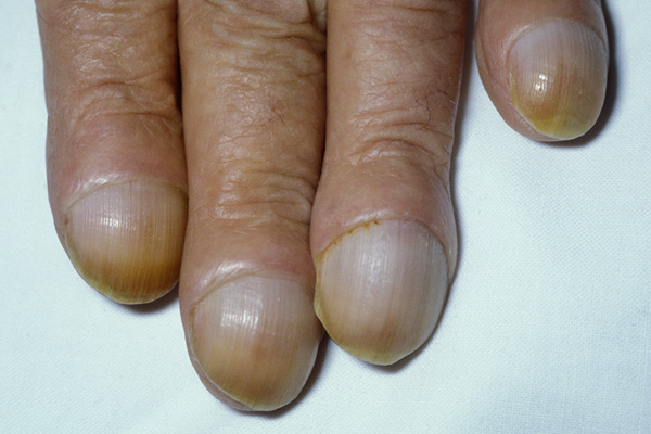 nail-disorders