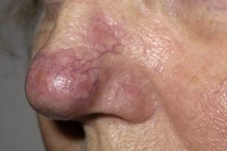 Rosacea May Be Independently Linked to Parkinson's Disease Rosacea May Be Independently Linked to Parkinson's Disease