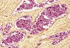 Treatment goal for acute myeloid leukemia Treatment goal for acute myeloid leukemia