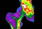 Osteoporosis screening in postmenopausal women Osteoporosis screening in postmenopausal women
