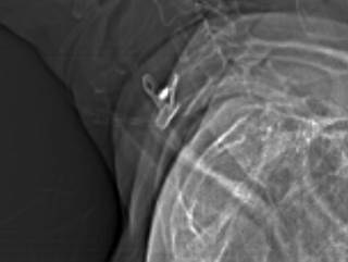 Neck CT was ordered to rule out perforation or abscess formation, but revealed an unknown object. Neck CT was ordered to rule out perforation or abscess formation, but revealed an unknown object.