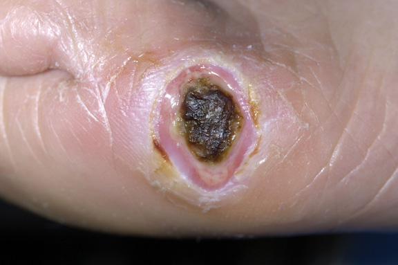 Diabetic foot ulcers in underinsured patients - The Clinical Advisor