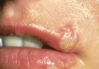 Blisters on the lip and in the mouth Blisters on the lip and in the mouth