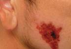 Nonhealing but painless cheek ulcer Nonhealing but painless cheek ulcer
