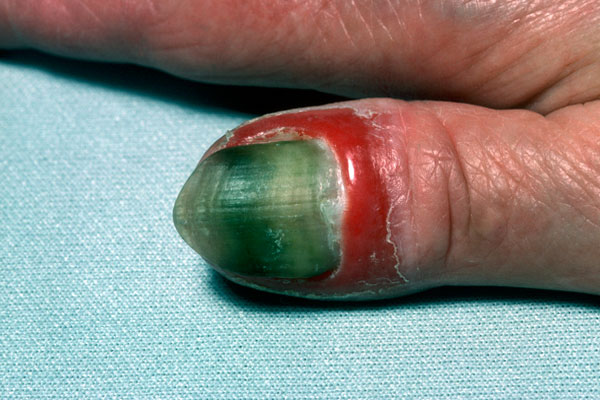 Psoriasis