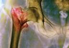 Osteoporosis in patients with CKD Osteoporosis in patients with CKD
