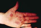 Rash on palms and arms and blister on lower lip Rash on palms and arms and blister on lower lip