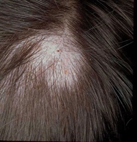 Slightly erythematous, scaly scalp lesion - The Clinical Advisor