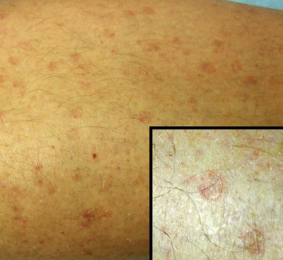 Scaly papules in sun-exposed areas - The Clinical Advisor