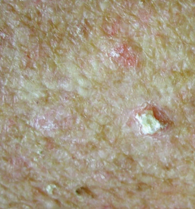 Scaly papules in sun-exposed areas - The Clinical Advisor