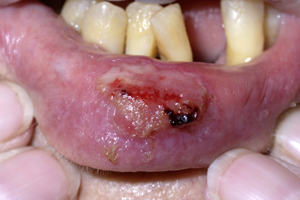 Methotrexate mouth sores pictures taking