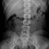 Unexplained low-back pain in an adolescent with scoliosis Unexplained low-back pain in an adolescent with scoliosis