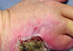 Nonhealing hand ulcer turns erythematous Nonhealing hand ulcer turns erythematous