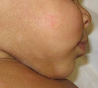 Infants with hypopigmented processes Infants with hypopigmented processes