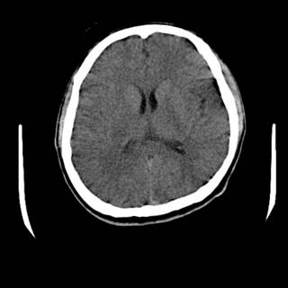 Acute onset of pain, numbness in the face, and slurred speech Acute onset of pain, numbness in the face, and slurred speech