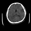 Acute onset of pain, numbness in the face, and slurred speech Acute onset of pain, numbness in the face, and slurred speech
