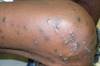 Intensely itchy rash erupts soon after hemodialysis begins Intensely itchy rash erupts soon after hemodialysis begins