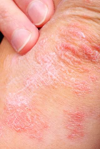 Psoriatic disease often undertreated, not treated Psoriatic disease often undertreated, not treated