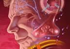 Obesity increases migraine risk Obesity increases migraine risk