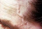 Treating giant cell arteritis to avoid complications Treating giant cell arteritis to avoid complications