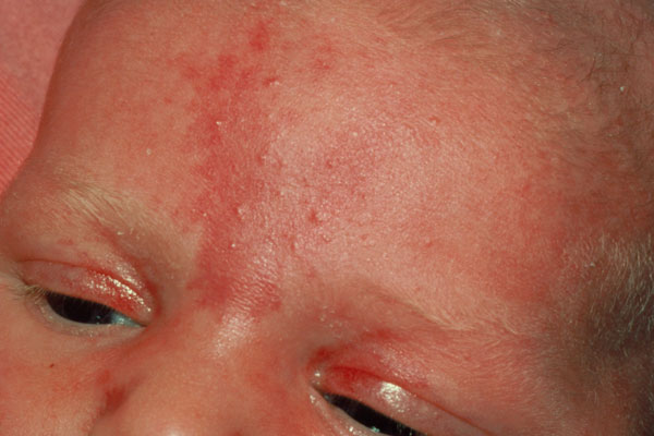 Hemangioma