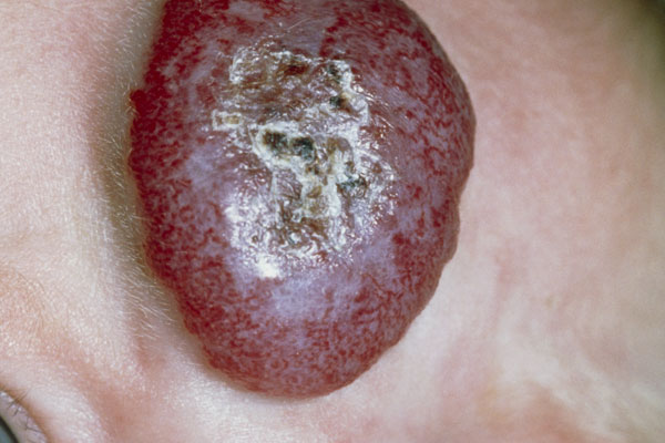 Hemangioma