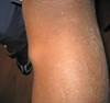 Painless bump on the leg for two years' duration Painless bump on the leg for two years' duration