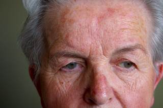 Research found an association, but no cause-and-effect relationship, between rosacea and Parkinson's. Research found an association, but no cause-and-effect relationship, between rosacea and Parkinson's.