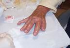 Blisters on the hands and fingers of a woman with discolored urine Blisters on the hands and fingers of a woman with discolored urine