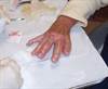 Blisters on the hands and fingers of a woman with discolored urine Blisters on the hands and fingers of a woman with discolored urine