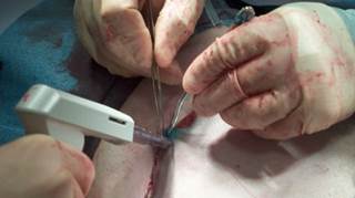 In a modified radical mastectomy (shown here), the axillary lymph nodes are also removed In a modified radical mastectomy (shown here), the axillary lymph nodes are also removed