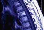 Use fracture risk to predict osteoporosis Use fracture risk to predict osteoporosis